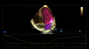Philips Ultrasound